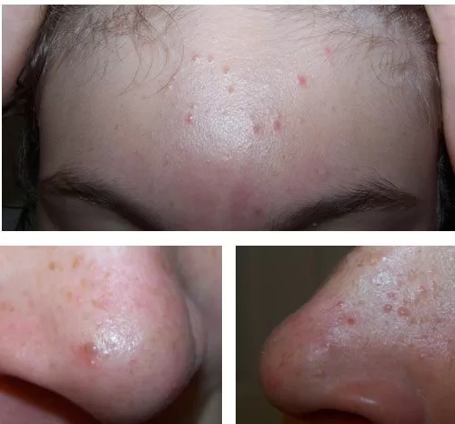 before-proactive proactiv review