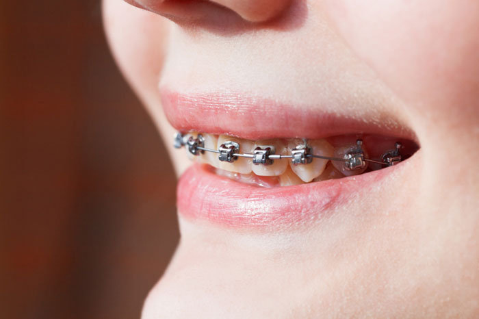 Myths About Braces