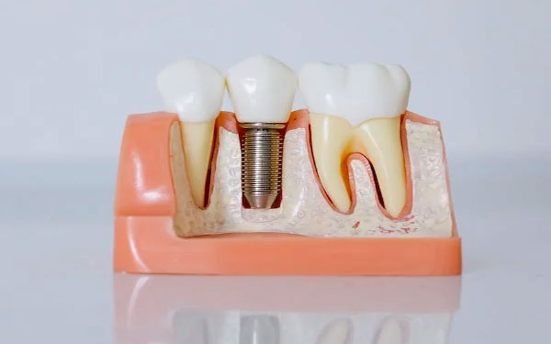 Dental Implants