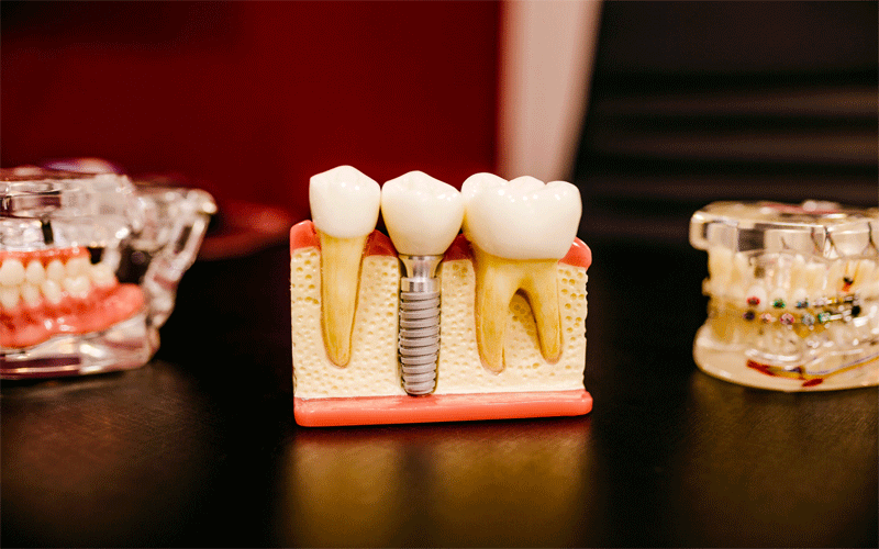 Dentures and Dental Implants